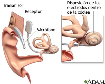 cochlear_implant