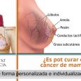 ¿Es pot curar el càncer de mama? – Ana Lluch – Catedràtica de Medina – Universitat de València – UV